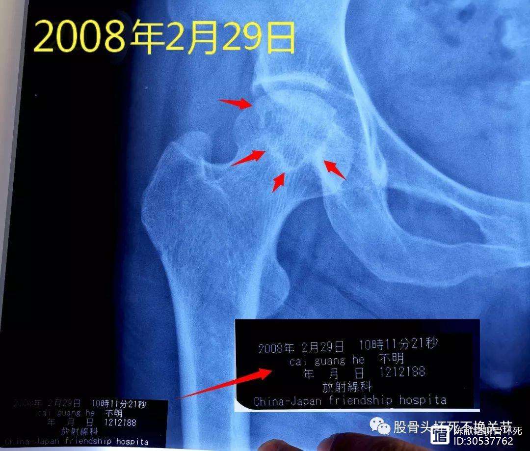 铜川人工骨头医保报销多少(人工骨头医保报销多少比例)