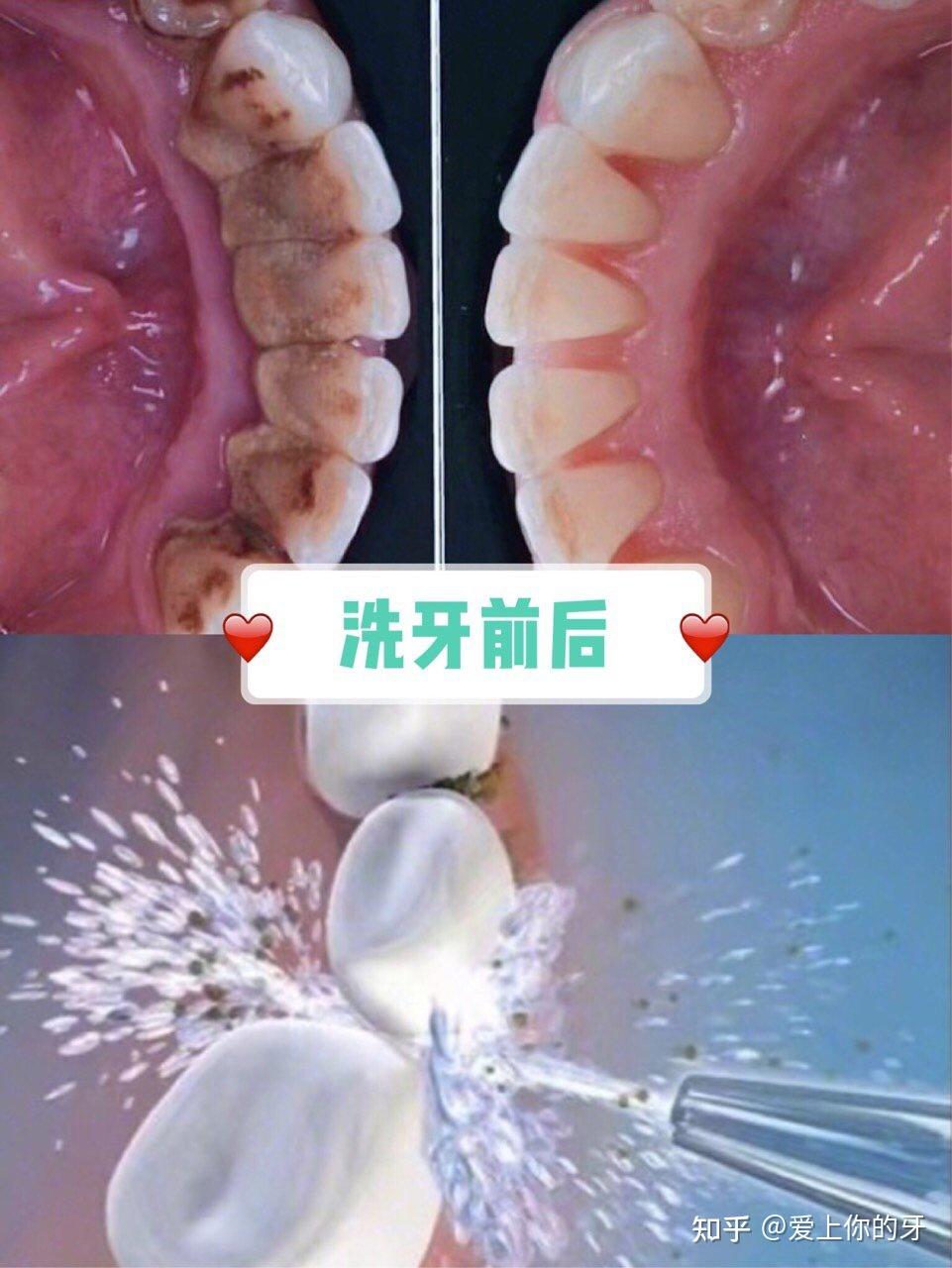 铜川洗牙可以用医保吗(洗牙可以用医保吗,报销比例多少)